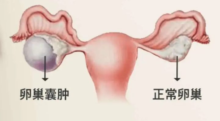 卵巢囊肿经常按这3个穴位，囊肿慢慢消失 